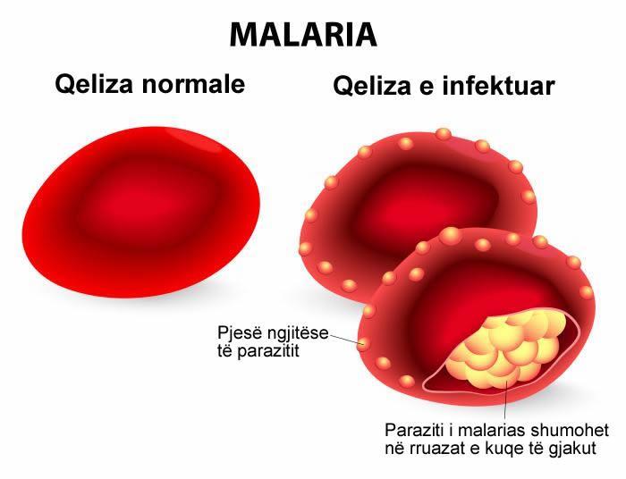 Qeliza e dëmtuar me sëmundjen malaria