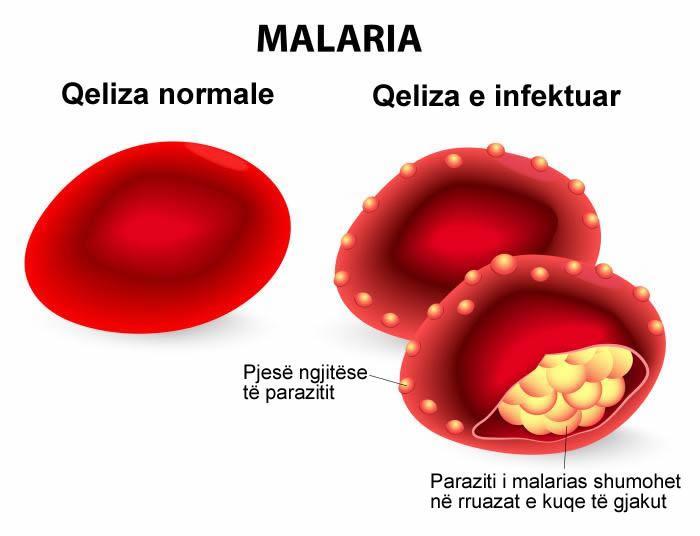 Qeliza e dmtuar me smundjen malaria