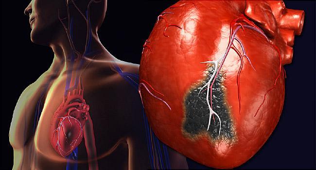 Nj nga shkaqet m t shpeshta t vdekjes n koht moderne sht ataku kardiak.