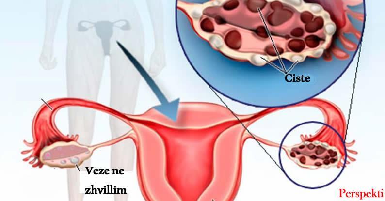 A jan cistet ovariane kancerogjene dhe a po ju rrezikojn shndetin?